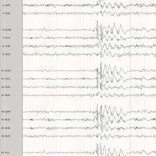 Dr. Gary Heiman Research Delivers New Hope For Epilepsy Patients